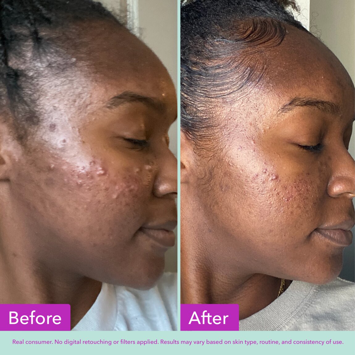 acne-foaming-cleanser-q8 zb_p.jpg
